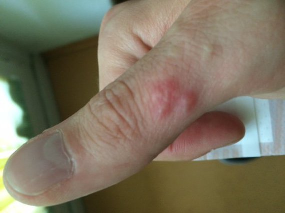 Comme le psoriasis de la photo des mains a lair