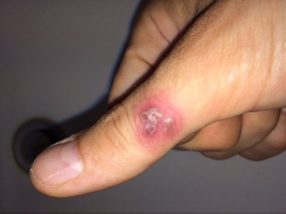 Le psoriasis comme la maladie