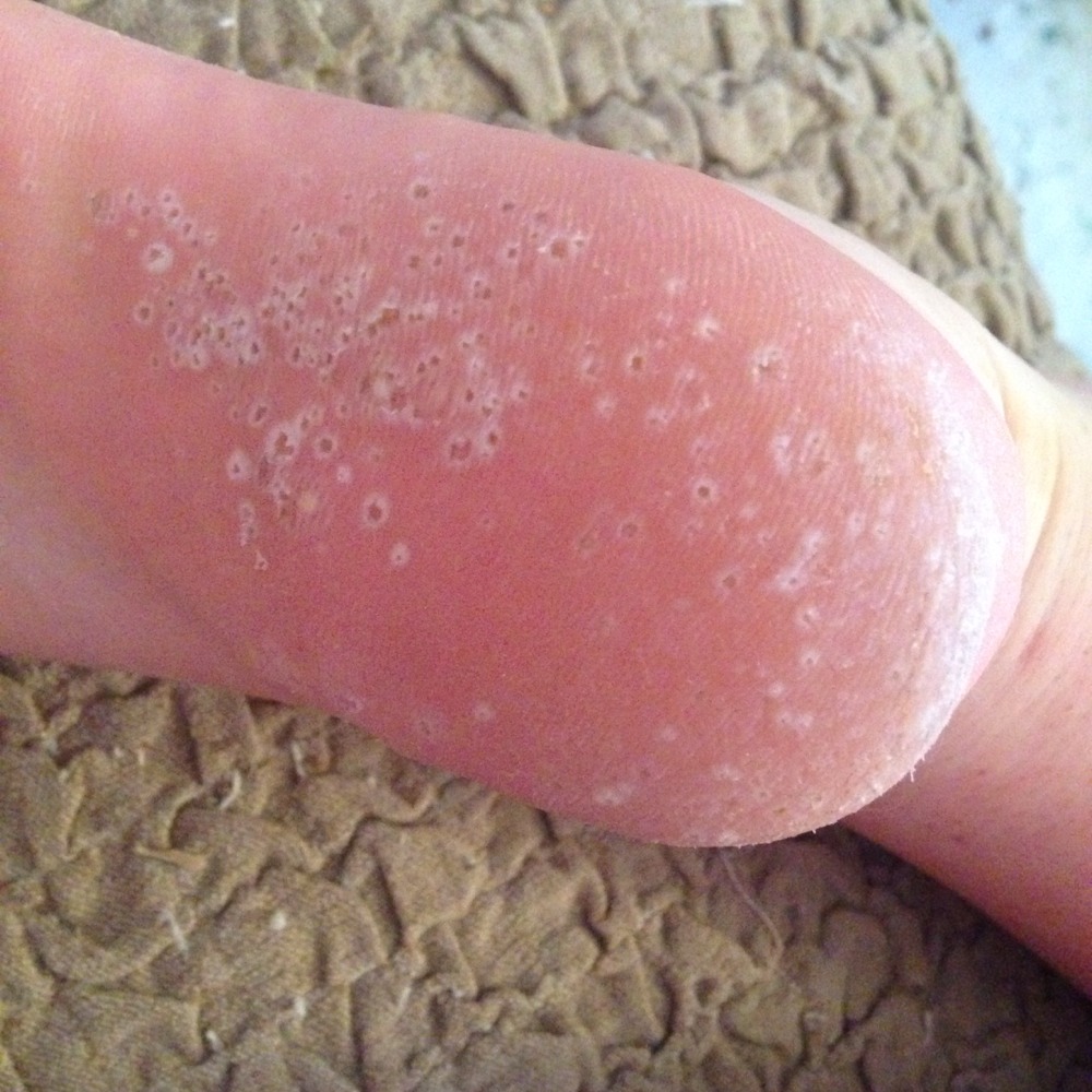 Le psoriasis sur la peau de la tête la raison