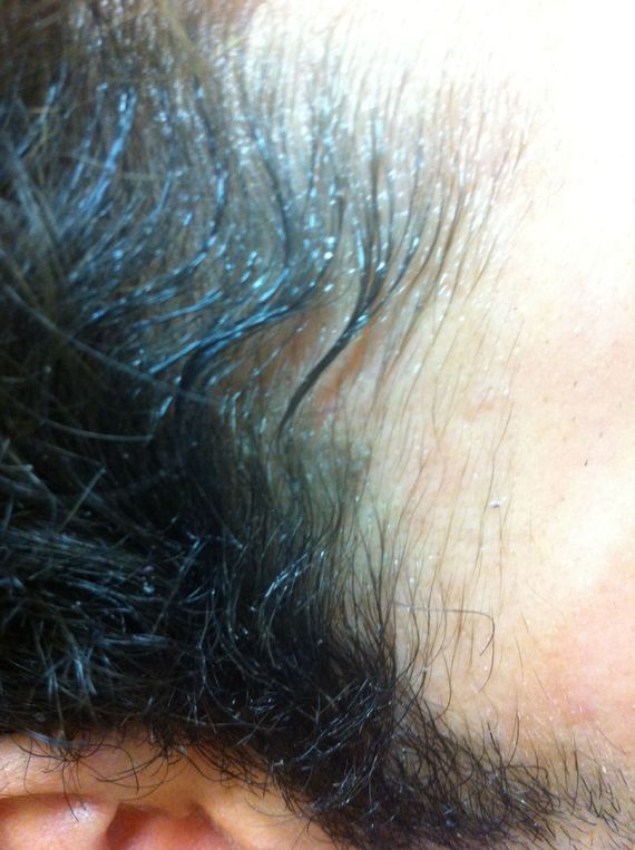Le Minoxidil pour les nuls - Calvitie et perte de cheveux Le Minoxidil pour les nuls - Calvitie et perte de cheveux