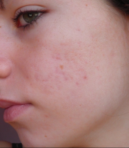 Le psoriasis par quel bon le comprimé