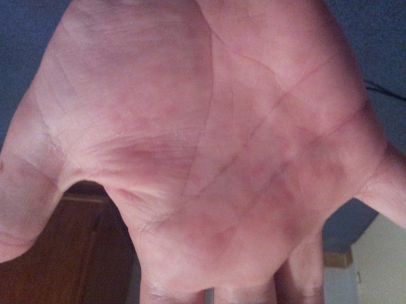 Linflammation des articulations des doigts des mains et le psoriasis