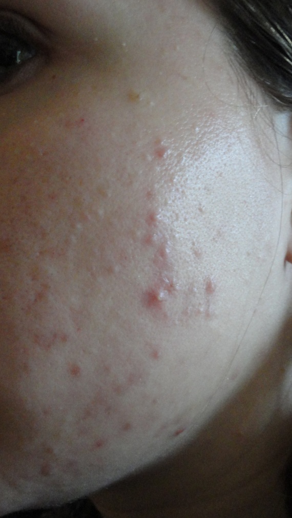 Traitement ROACCUTANE et conseils (fond de teint, etc Traitement ROACCUTANE et conseils (fond de teint, etc
