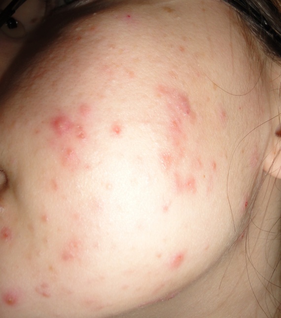 Traitement ROACCUTANE et conseils (fond de teint, etc Traitement ROACCUTANE et conseils (fond de teint, etc