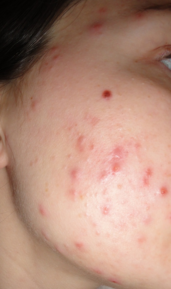 Traitement ROACCUTANE et conseils (fond de teint, etc Traitement ROACCUTANE et conseils (fond de teint, etc