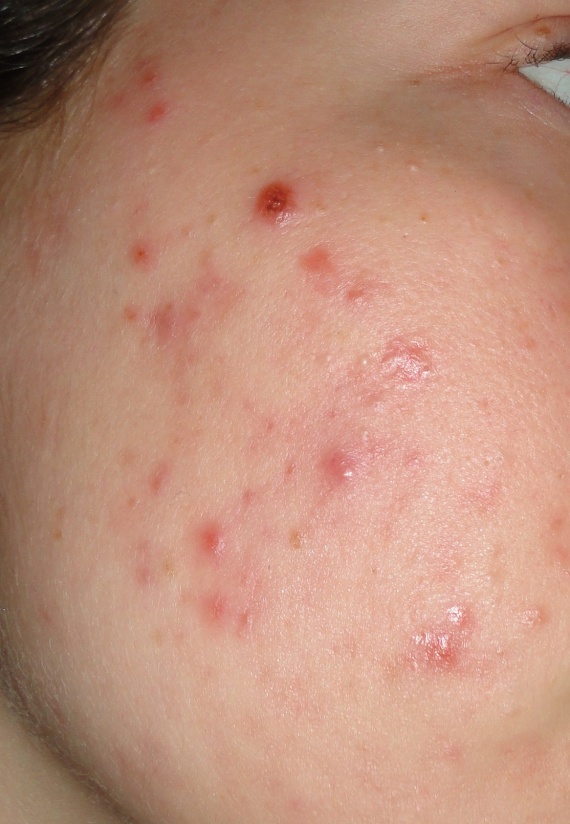 Traitement ROACCUTANE et conseils (fond de teint, etc Traitement ROACCUTANE et conseils (fond de teint, etc