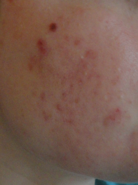 Traitement ROACCUTANE et conseils (fond de teint, etc Traitement ROACCUTANE et conseils (fond de teint, etc