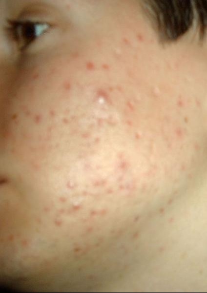 Comme se forme le psoriasis de vidéo