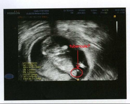 echographie grossesse 1 mois echographie grossesse 1 mois