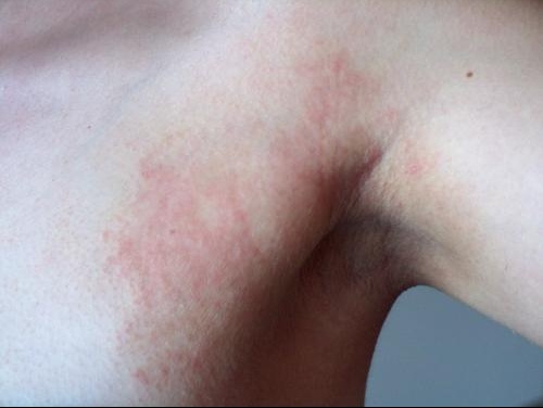 Comme se mettre à parler au psoriasis ou leczéma