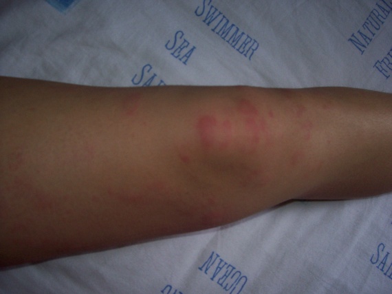 Corso di eczema di una malattia