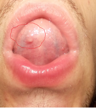 Asd-2 Le schéma de laccueil au psoriasis