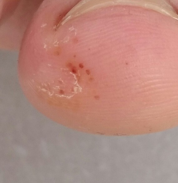Traitement de l'ongle incarné par phénolisation ;الدكتور Traitement de l'ongle incarné par phénolisation ;الدكتور