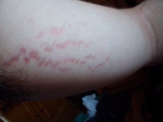 Gotta a eczema