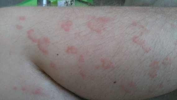 Les taches de pigment depilyatsii comme enlever