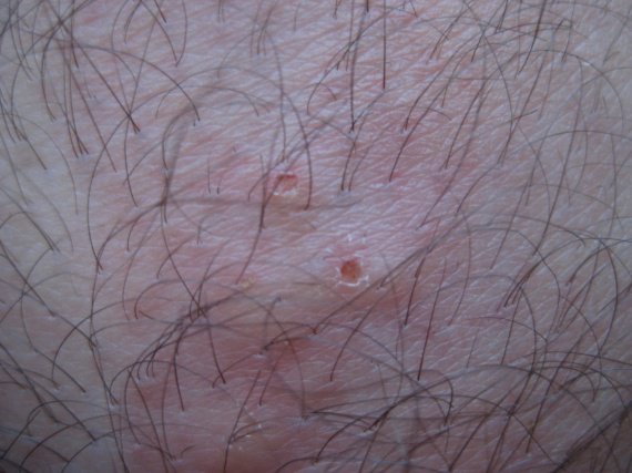 Leczéma microbien trempant
