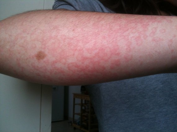 routine capillaire: Comment guerir un psoriasis du cuir routine capillaire: Comment guerir un psoriasis du cuir