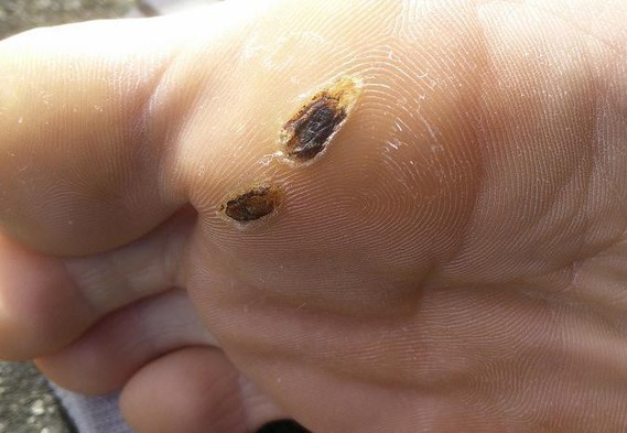 La prophylaxie seborejnoj les eczémas