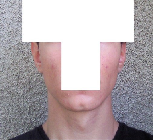 Roaccutane Douleur Dos - Brand cialis canada Roaccutane Douleur Dos - Brand cialis canada