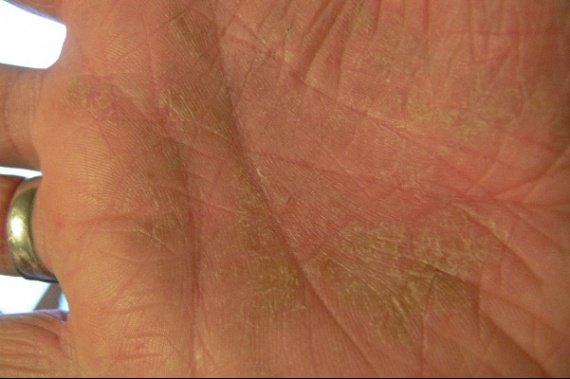 Les eczémas sur les yeux