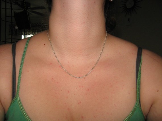 Linflammation des boutons sur la personne de la photo