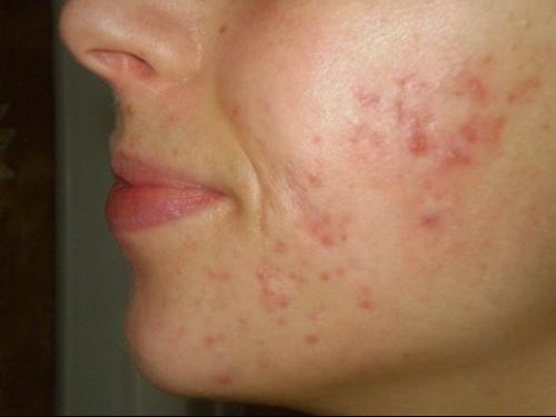 Les conseils par le psoriasis malade