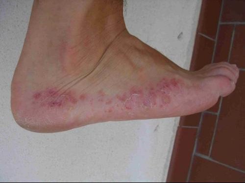 Le psoriasis sur la personne à spb