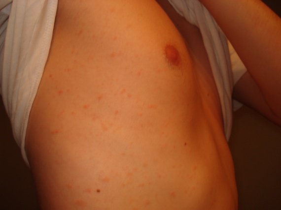 Le psoriasis inverse de la peau