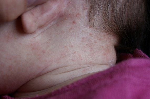 Le shampooing du psoriasis de la tête izrail