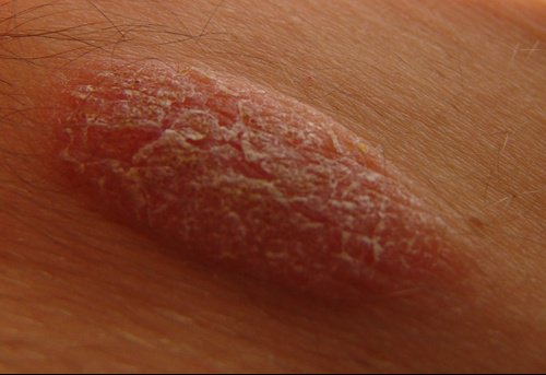 De quoi le psoriasis de la tête arrive