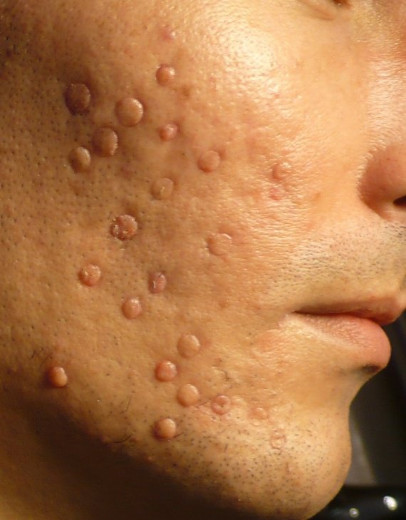 L'ixekizumab, un nouveau traitement contre le psoriasis L'ixekizumab, un nouveau traitement contre le psoriasis