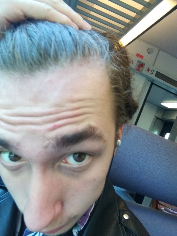 20 ans Début de calvitie ? Que faire ? Calvitie et perte de cheveux FORUM Santé