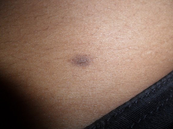 Comme enlever les taches de pigment et dans la zone du bikini