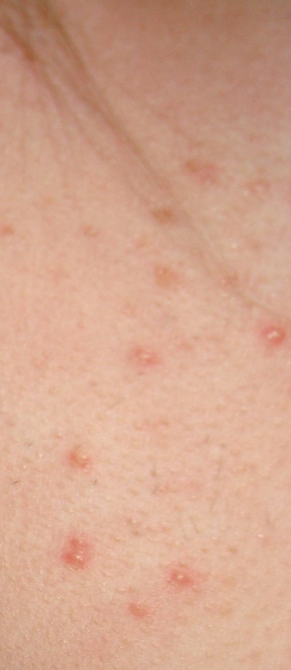 Lindice dermatologique de lacné