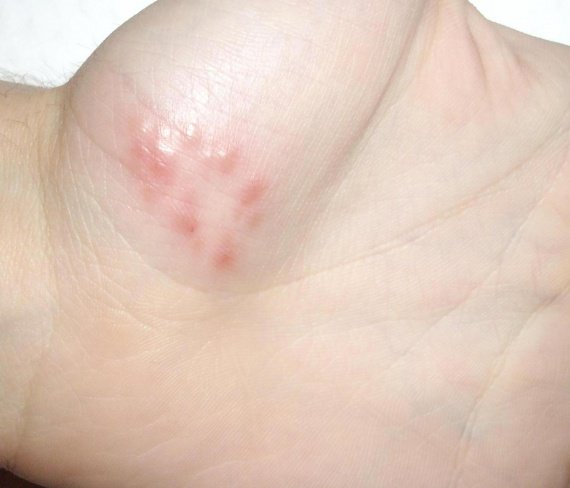 Le traitement du psoriasis par le solarium