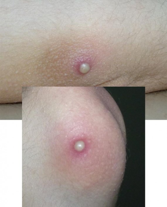 La crème-cire est saine du psoriasis dans la pharmacie