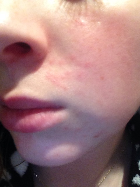 Droles de boutons - Allergies et eczéma - FORUM Santé Droles de boutons - Allergies et eczéma - FORUM Santé