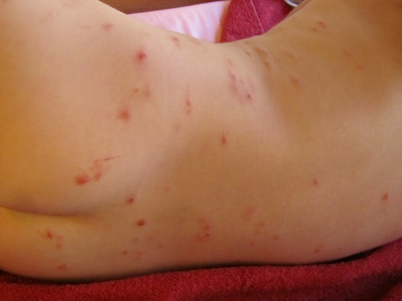 Comme se délivrer des boutons inflammatoires sur la personne