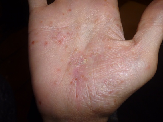 Si on peut les pommes de terre au psoriasis