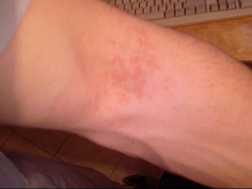 Comme traiter le psoriasis par lozone