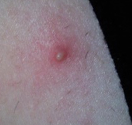 La mer morte du moyen du psoriasis sur