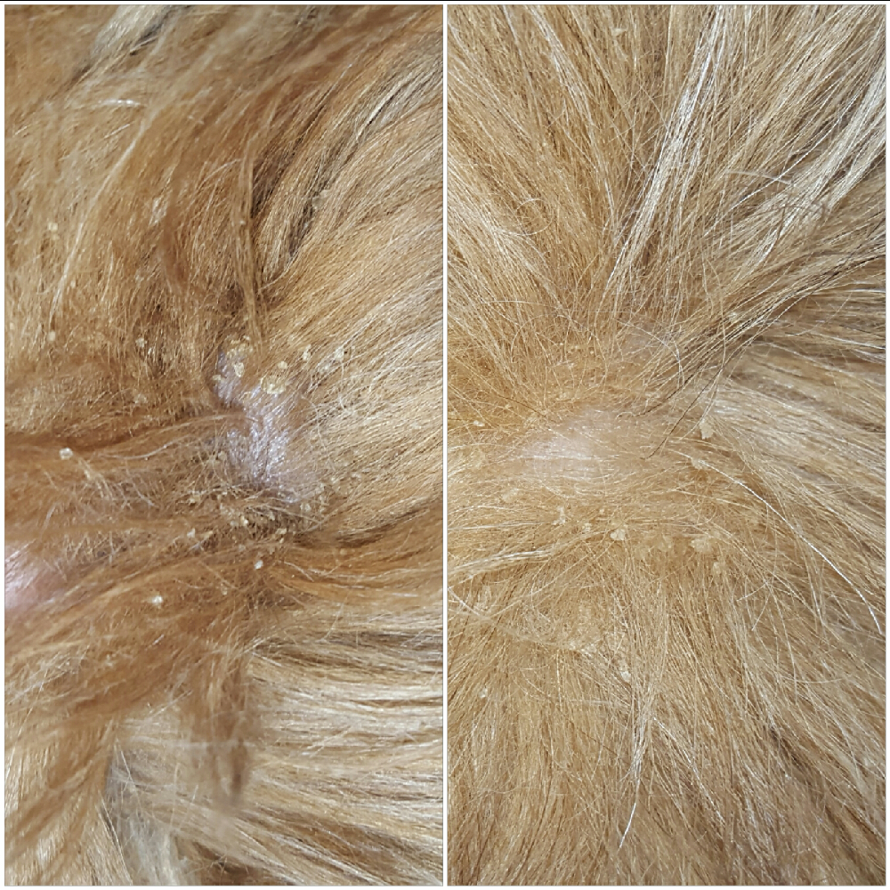 nouveau traitement psoriasis 2015
