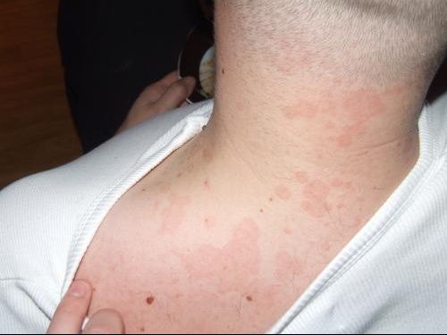 Le traitement du psoriasis par la coquille