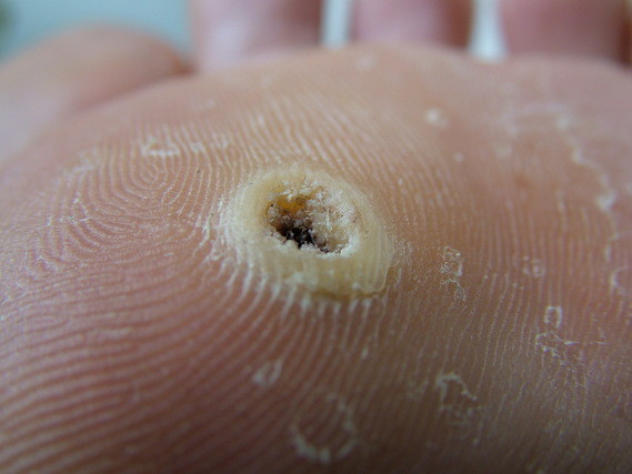 Si levomekol et le psoriasis on peut appliquer