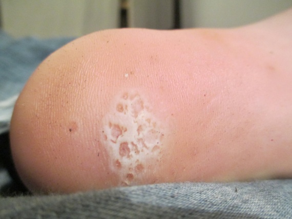 Atopitchesky la dermatite le traitement national