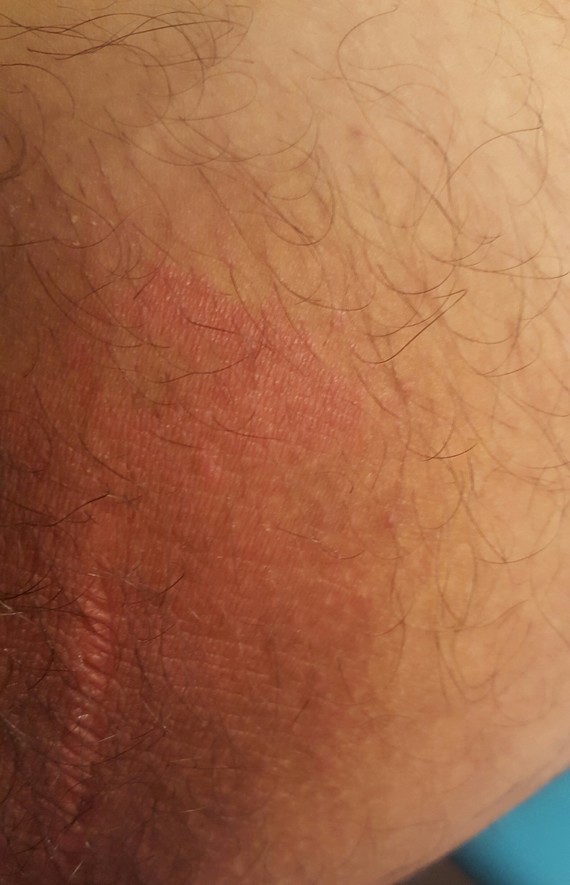 La crème de la pigmentation sur la peau de la personne