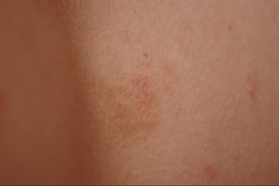 Les connaissances avec les gens avec le psoriasis