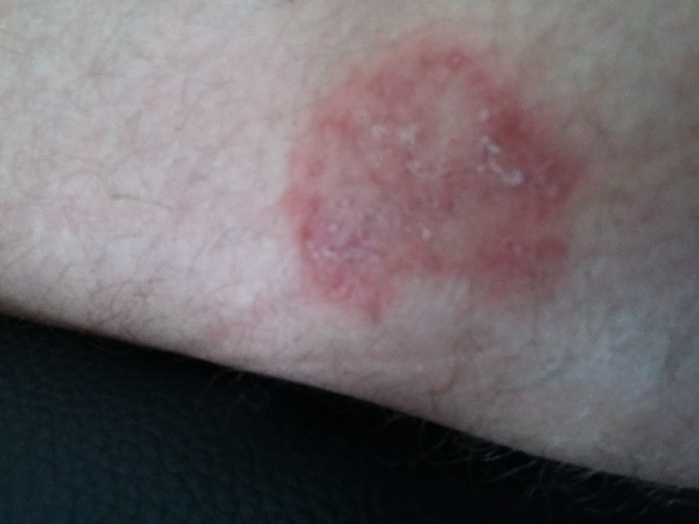 Les éruptions sur la peau le psoriasis