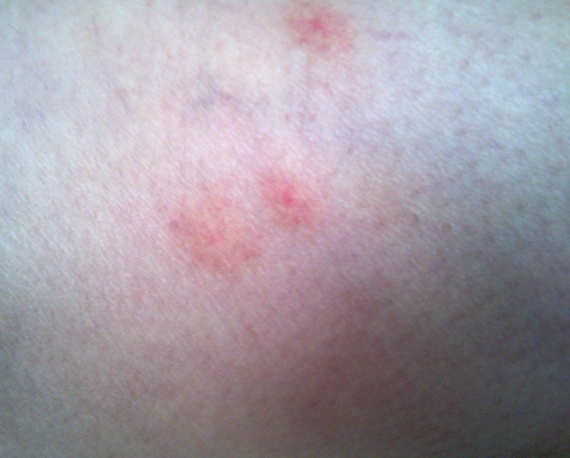 allergie aux chatons? - Allergies et eczéma - FORUM Santé allergie aux chatons? - Allergies et eczéma - FORUM Santé