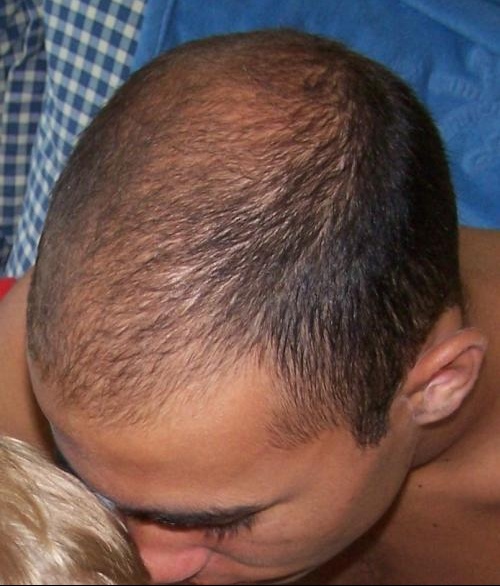 jeune et chauve? - Calvitie et perte de cheveux - FORUM Santé jeune et chauve? - Calvitie et perte de cheveux - FORUM Santé